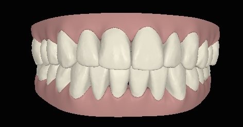 Engstand schneidezaehne-verschieben-sich05 fronttal digital