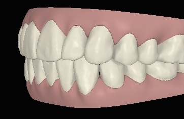 Engstand schneidezaehne-schief06 digital links