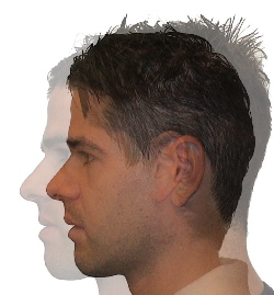 Vergleich-Vorbiss Behandlung mit Invisalign vorher und nachher