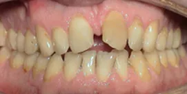 Zahnlücke frontal Patient