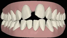 Zahnlücke digital Frontal